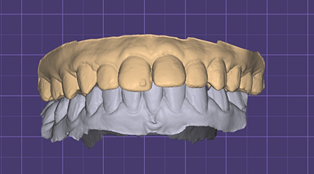 Cad Cam-vinayaga dental lab